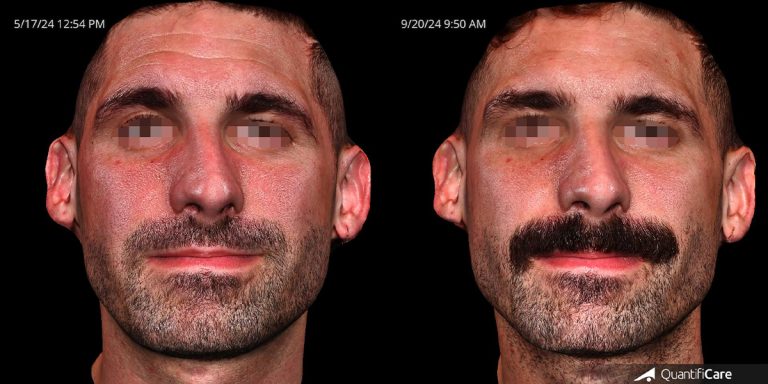 before and after facial filler male patient front view Case 4552