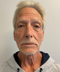 before filler front view male patient case 4578