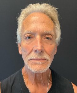 after filler front view male patient case 4578